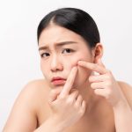 Penyebab Jerawat dan Cara Mencegahnya 