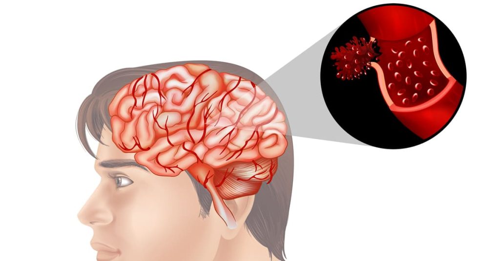 ini-dia,-8-penyebab-pembuluh-darah-pecah-yang-harus-diwaspadai
