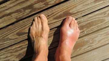 7-penyebab-asam-urat-di-usia-muda,-salah-satunya-mager!