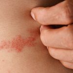 Apa itu Penyakit Herpes? Ini Gejala, Faktor Risiko dan Pengobatannya