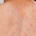 7 Gejala Penyakit Rubella, Penyebab dan Pencegahannya