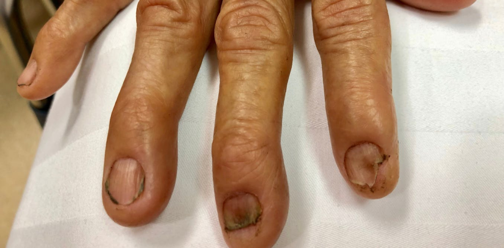 tampilan-kuku-bisa-menunjukkan-kondisi-kesehatan-kamu