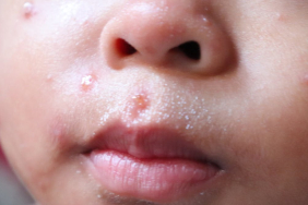 kasus-campak-indonesia-tertinggi-kedua-di-dunia:-efek-mengerikan-hoaks-dan-narasi-antivaksin