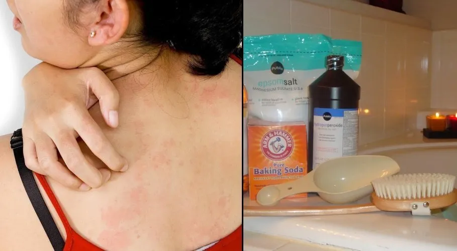 7-tips-obati-biang-keringat-saat-cuaca-panas,-kulit-badan-mulus-lagi-tanpa-bercak