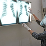 deteksi-tuberkulosis-pakai-ai-cepat-dan-akurat:-mampukah-menjawab-keterbatasan-dokter-di-daerah?